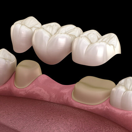 Dental bridge of 3 teeth over molar and premolar. Medically accurate 3D illustration of human teeth treatment