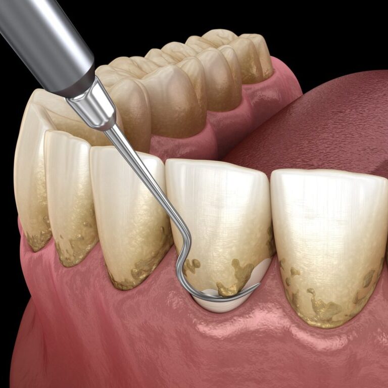 Capital_Dental_Lincoln_Nebraska_Peridontal_Disease_Gum_Disease_2-1024x768