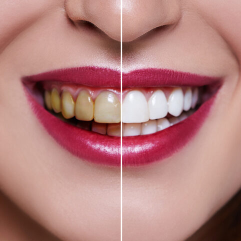 before and after teeth whitening close-up