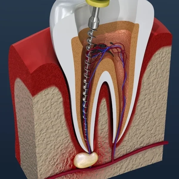 root canal treatment-078475-edited